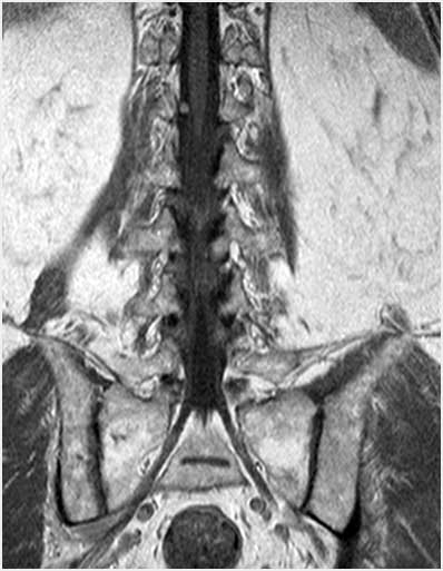 MRI of my spine